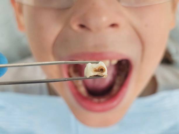 Best Same-Day Emergency Dentist in Collinsville, VA